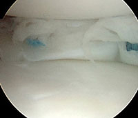 Arthroscopic image of a completed meniscus