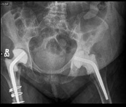 A hip spacer is placed