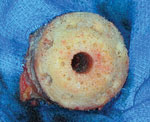 A well-prepared femoral head