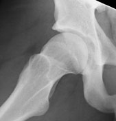 Preoperative frog-leg lateral X-ray