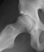 Postoperative frog-leg lateral X-ray