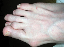 Clinical photograph of the preoperative deformity