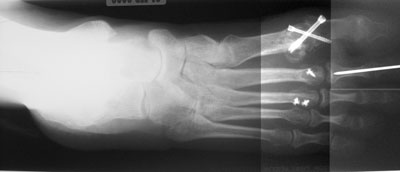 Postoperative radiograph showing correction of hallux valgus angle 