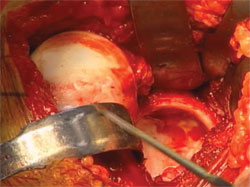 Photograph of right hip with the femoral head subluxed posterior