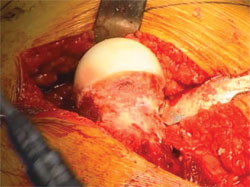 The same hip after osteochondroplasty