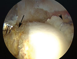 A supine arthroscopic view after rim trimming and labral refixation