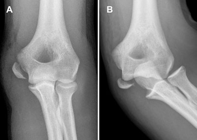 An ustable elbow following medial epicondyle fracture