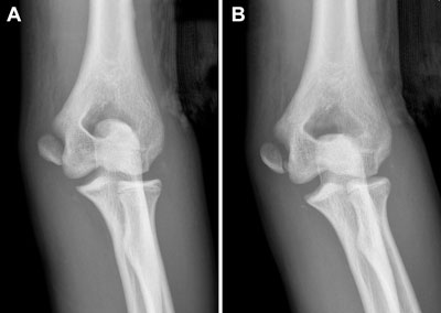 A stable elbow following medial epicondyle fracture