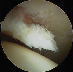 a delamination of the acetabular cartilage