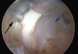 Supine arthroscopic image