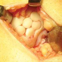 A miniarthrotomy mosaicplasty