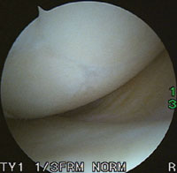 A second-look arthroscopy