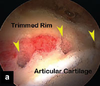 Fig. a: Anterosuperior acetabular rim after trimming