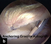 Fig. b: Gracilis tendon autograft