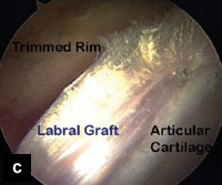 Fig. c: Labral reconstruction