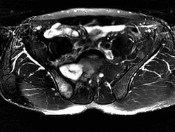 Lobulated lesion