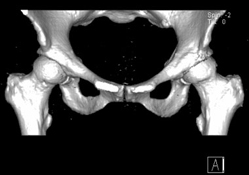 3-D helical CT