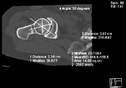 CT scan, femoral head