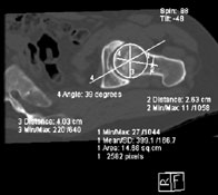 CT scan, femoral head