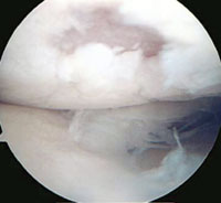 Focal cartilage delamination