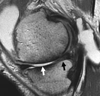 Chronic effusion