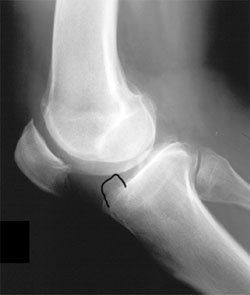 Anterior anvil osteophyte