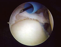 Increased labral fraying