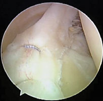 Inverted vertical mattress suturing