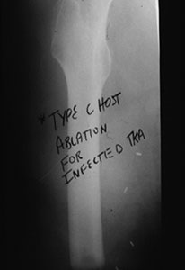 Type C host, ablation for infected TKA