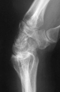 Lateral radiograph, distal radius malunion