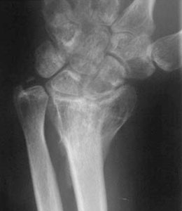 AP radiograph, distal radius malunion