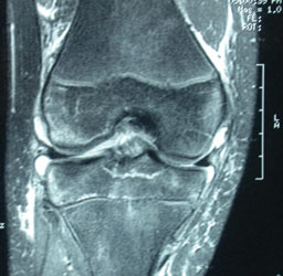 Nondisplaced tibial spine avulsion