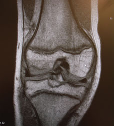 Bone contusion in the lateral compartment