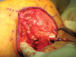 SMCL and POL grafts