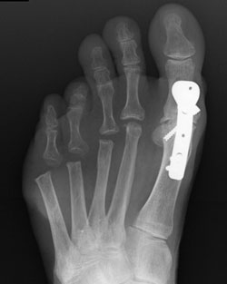 Fixation of a hallux MP joint