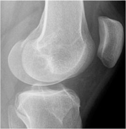 Massive tibial tunnel osteolysis