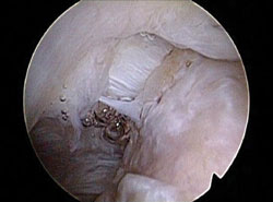 Partial rotator cuff tear