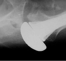 Acute posterior dislocation following TSA.