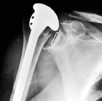 Superior instability in rotator cuff