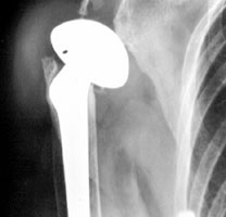 Inferior instability in rotator cuff