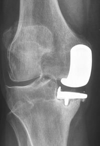 Failed unicompartmental knee replacement