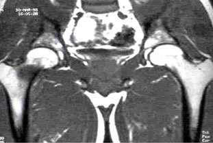 Femoral neck stress fracture