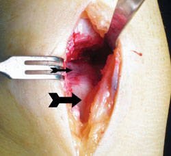 Medial arthrotomy