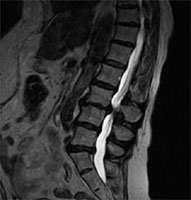 Preoperative disc height