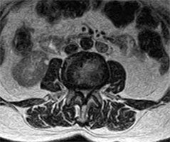 Lumbar stenosis