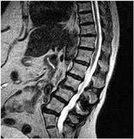 2-year postoperative disc height