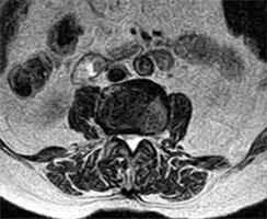 Less stenotic central lumbar canal