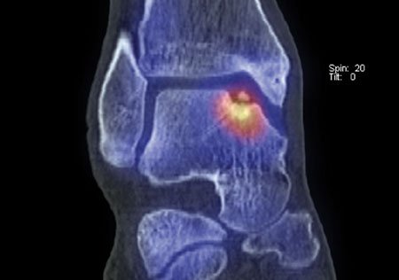 Large osteochondral lesion