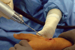 T-Pin minimally invasive