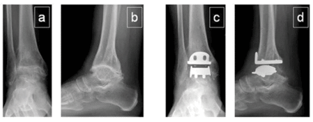 grade IV ankle arthritis